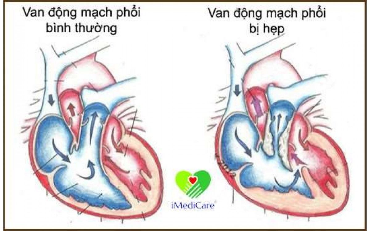 Bệnh hẹp động mạch phổi đơn thuần